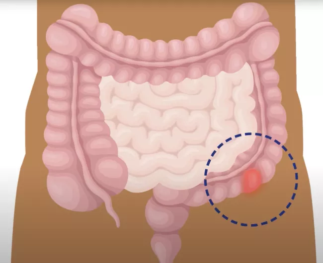 robotic assisted surgery video image